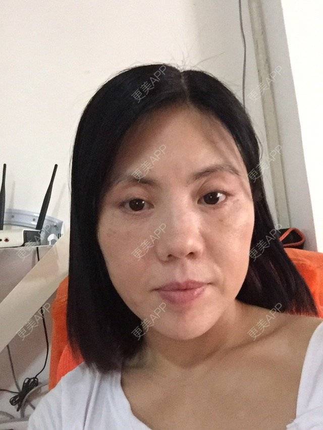 更美 - 微笑118的经验 | 童颜针 | 深圳