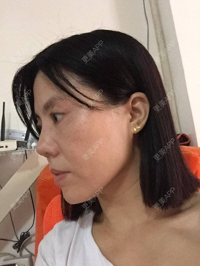 更美 - 微笑118的经验 | 童颜针 | 深圳