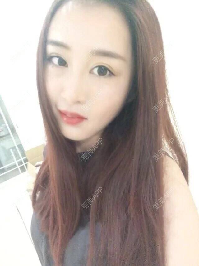 更美 - 小王王的经验 | 美购日记 | 终身包干 | 面部轮廓 | 自体脂肪填充面部手术 | 重庆