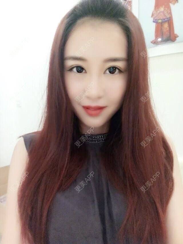 更美 - 小王王的经验 | 美购日记 | 终身包干 | 面部轮廓 | 自体脂肪填充面部手术 | 重庆