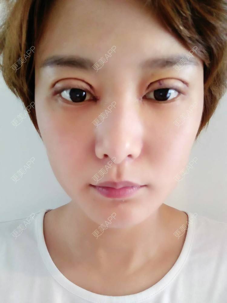 更美 - 橙美美的定点双眼皮经验 | 术后求抱抱 | 双眼皮开眼角 | 全切双眼皮 | 定点双眼皮 | 青岛