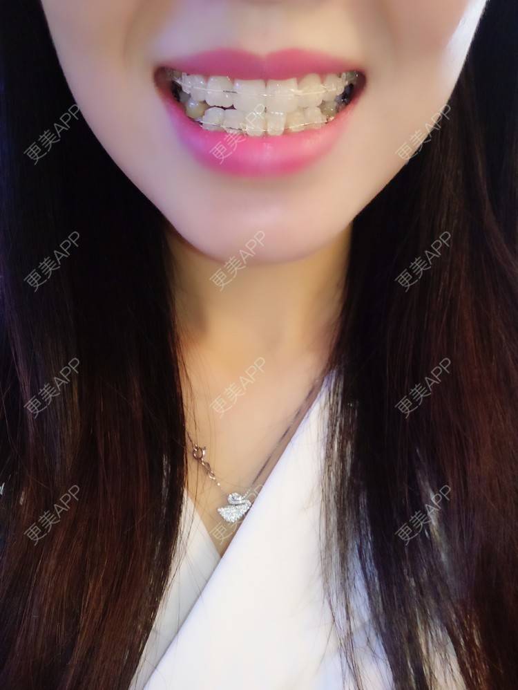 wuyixuan的隐形牙齿矫正日记