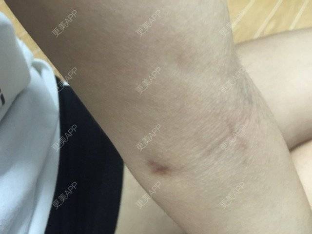 更美 - 你是不是sha的经验 | 美购日记 | 抽脂瘦手臂 | 抽脂瘦大腿 | 瘦身美体 | 武汉