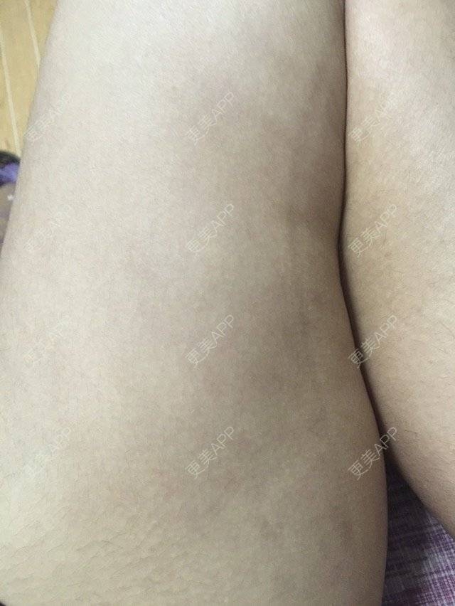 更美 - 你是不是sha的经验 | 美购日记 | 抽脂瘦手臂 | 抽脂瘦大腿 | 瘦身美体 | 武汉
