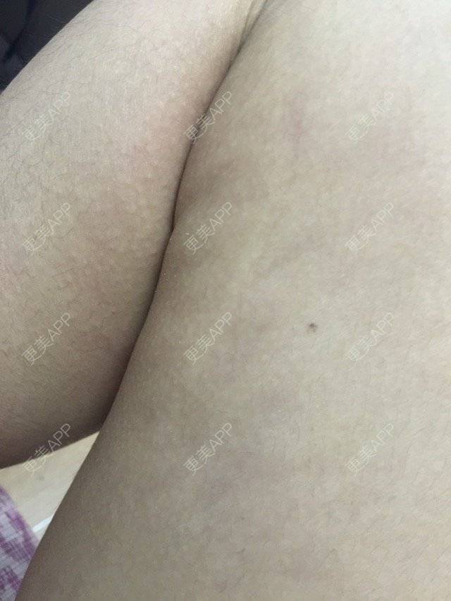 更美 - 你是不是sha的经验 | 美购日记 | 抽脂瘦手臂 | 抽脂瘦大腿 | 瘦身美体 | 武汉