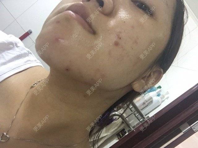 更美 - 小雪妹妹的果酸焕肤经验 | 果酸焕肤 | 果酸祛痘 | 皮肤美容 | 北京