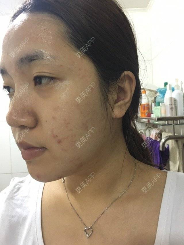 更美 - 小雪妹妹的果酸焕肤经验 | 果酸焕肤 | 果酸祛痘 | 皮肤美容 | 北京