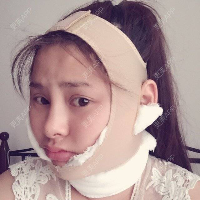 更美 - yiliaxx的吸脂瘦脸经验 | 美购日记 | 脸部抽脂 | 吸脂瘦脸 | 西安