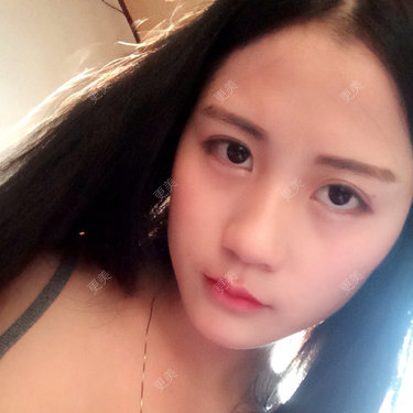 自体脂肪面部年轻化