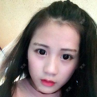 自体脂肪面部年轻化