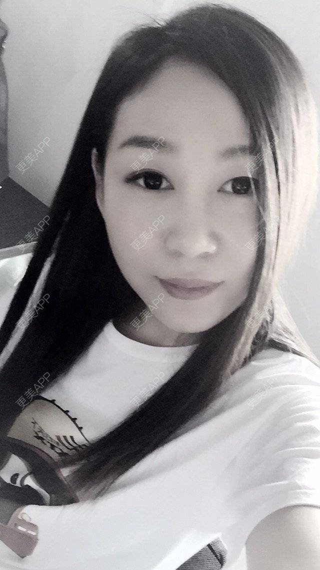 更美 - weenie的玻尿酸经验 | 美购日记 | 玻尿酸注射法令纹下巴 | 玻尿酸 | 深圳