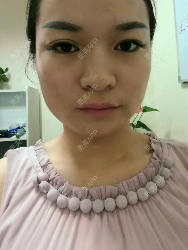 更美 - 淺眸丶流年的经验 | 除皱瘦脸 | 杭州 | 热门讨论