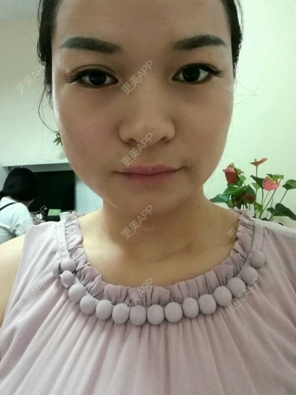 更美 - 淺眸丶流年的经验 | 除皱瘦脸 | 杭州 | 热门讨论