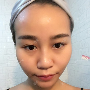 太阳穴