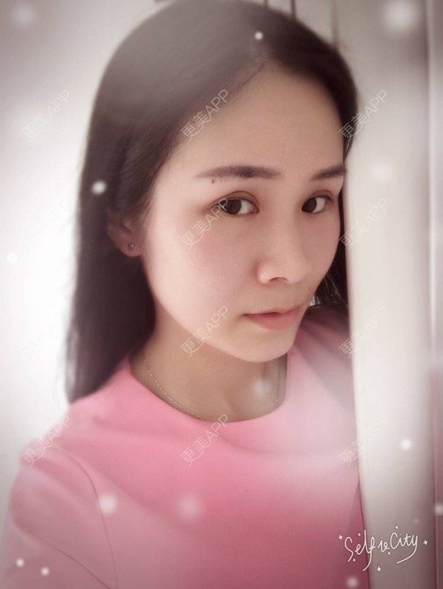 更美 - 更美用户bmlscOEFPh的开内眼角经验 | 开内眼角 | 益阳 | 双眼皮