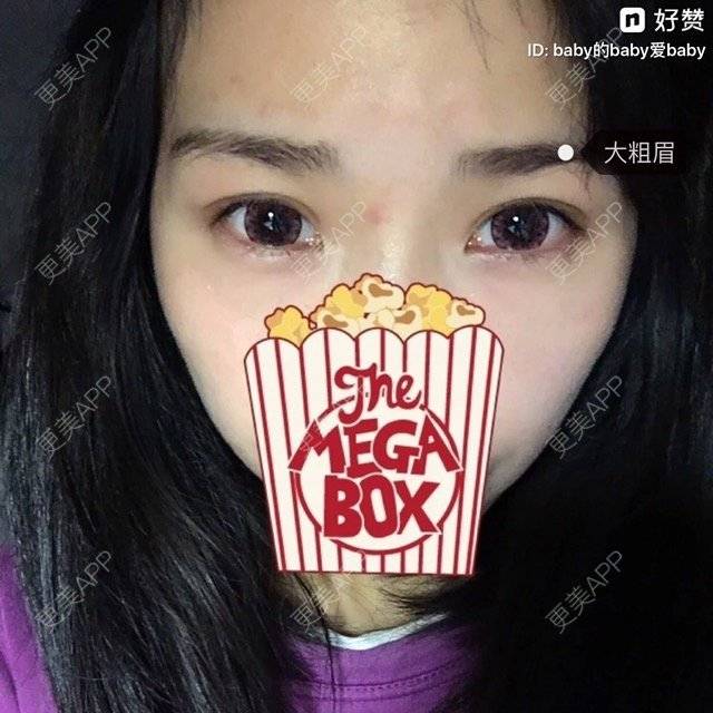 更美 - 小丸子的吊带裙的双眼皮经验 | 美购日记 | 眼部整形 | 双眼皮 | 沈阳