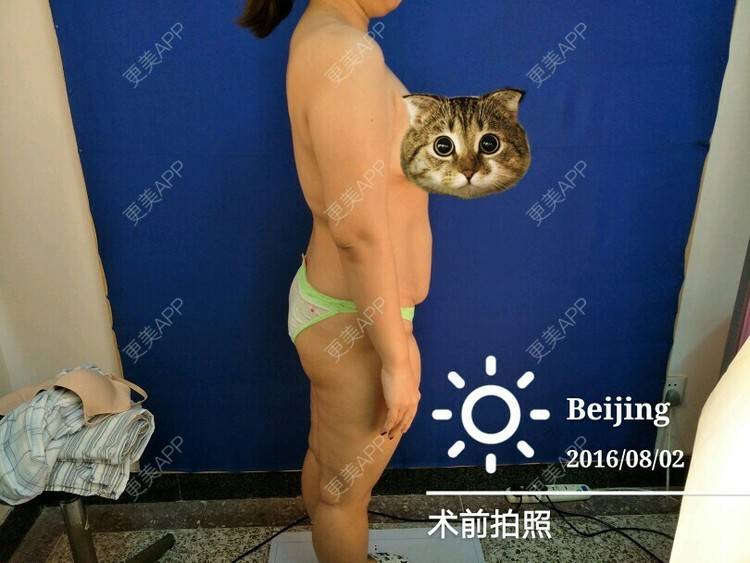 更美 - 樱桃的滋味儿的经验 | 美购日记 | 上臂吸脂 | 北京