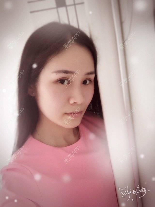 更美 - 更美用户bmlscOEFPh的开内眼角经验 | 开内眼角 | 益阳 | 双眼皮