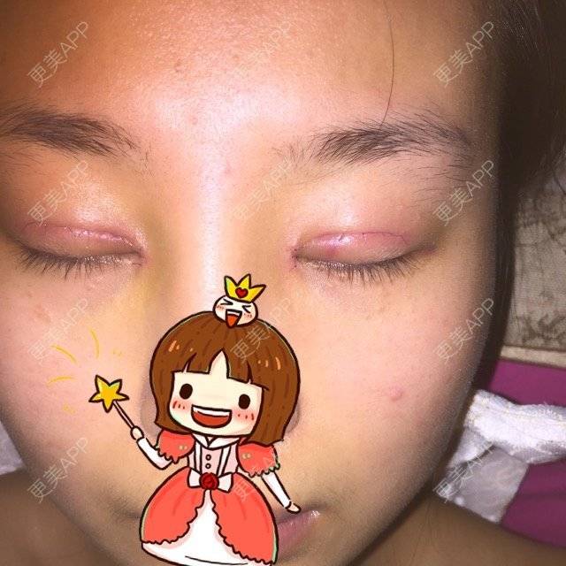 更美 - 九尾猫的日记的双眼皮经验 | 美购日记 | 开眼角 | 翘睫 | 精切双眼皮 | 双眼皮 | 武汉