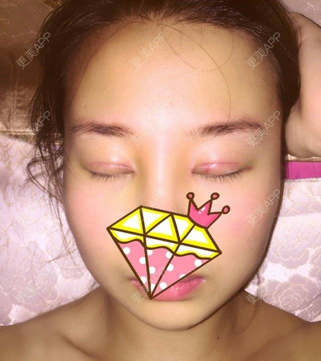 更美 - 九尾猫的日记的双眼皮经验 | 美购日记 | 开眼角 | 翘睫 | 精切双眼皮 | 双眼皮 | 武汉