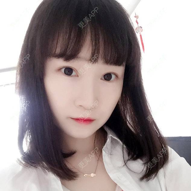 更美 - since biu的全切双眼皮经验 | 唐山 | 全切双眼皮 | 双眼皮