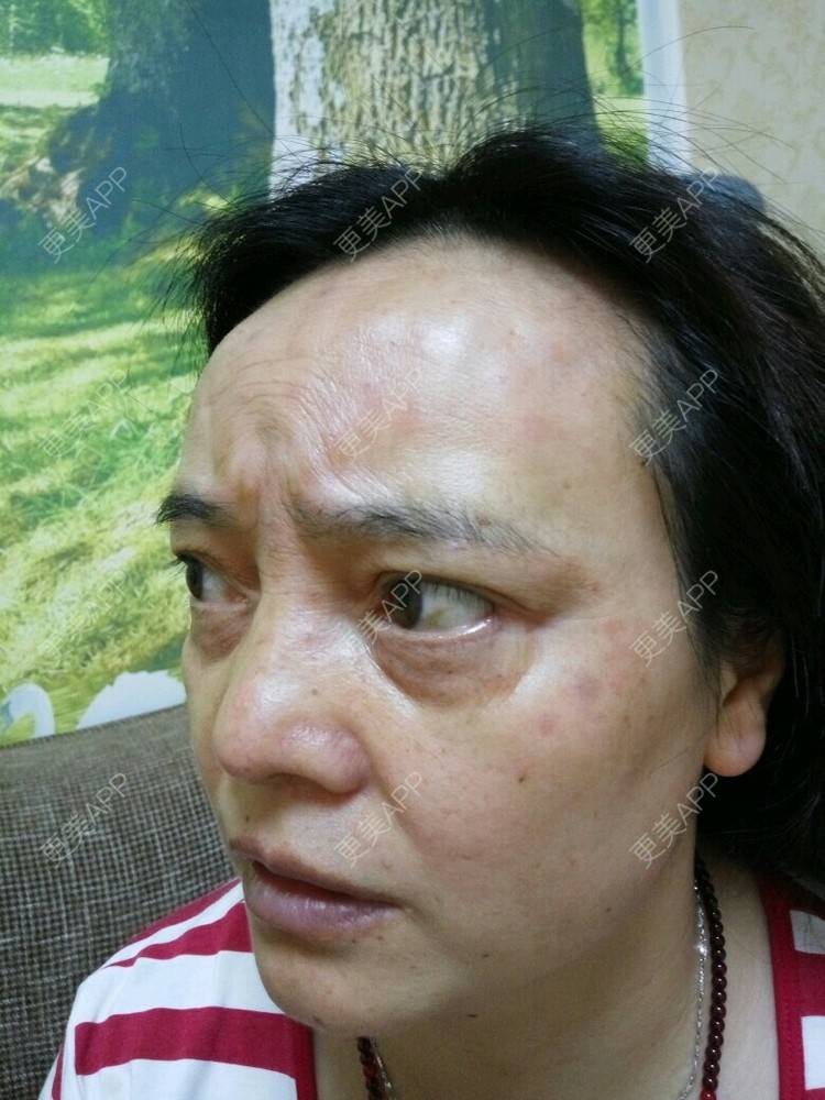 更美 - 更美用户0BUephUhtV的眼部护理经验 | 注射美容 | 眼部整形 | 眼部护理 | 除皱 | 成都