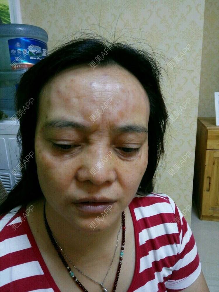 更美 - 更美用户0BUephUhtV的眼部护理经验 | 注射美容 | 眼部整形 | 眼部护理 | 除皱 | 成都