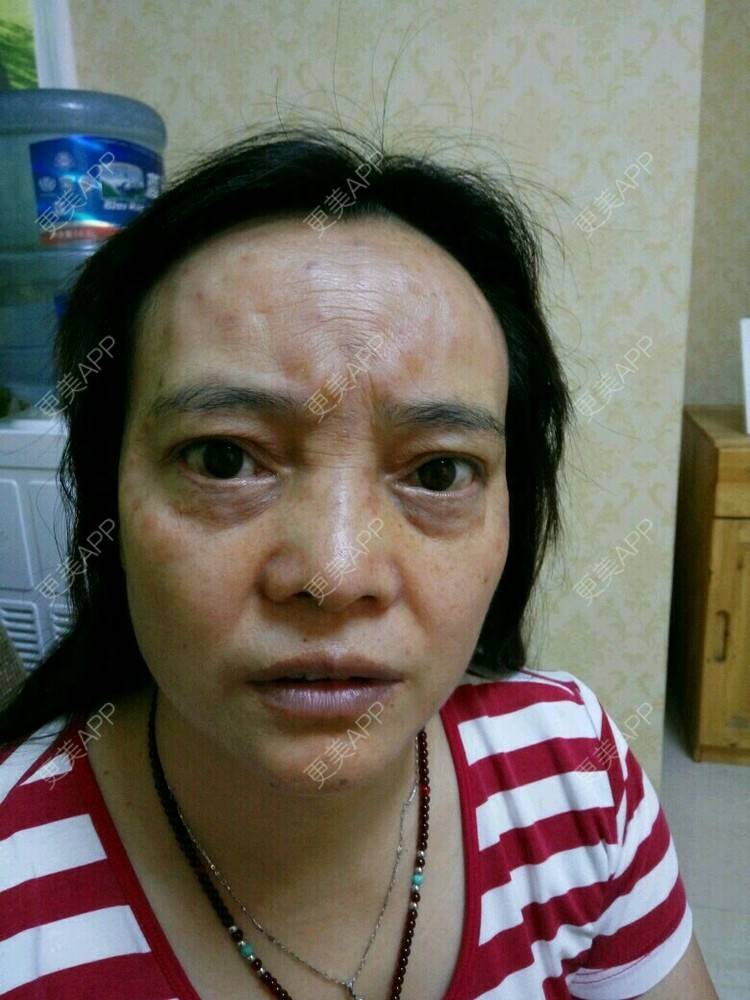 更美 - 更美用户0BUephUhtV的眼部护理经验 | 注射美容 | 眼部整形 | 眼部护理 | 除皱 | 成都