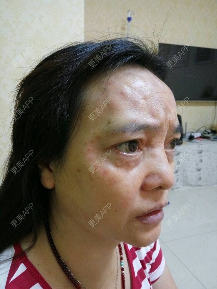 更美 - 更美用户0BUephUhtV的眼部护理经验 | 注射美容 | 眼部整形 | 眼部护理 | 除皱 | 成都