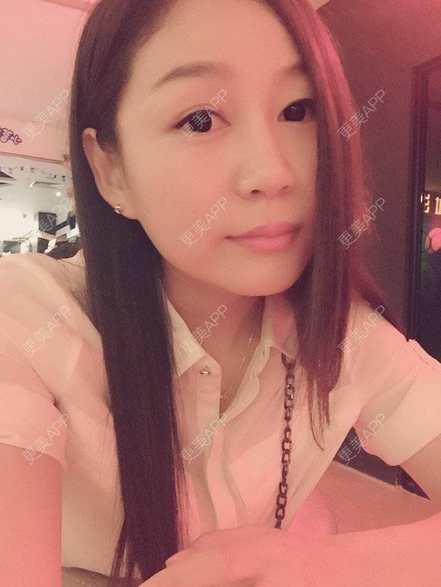更美 - weenie的玻尿酸经验 | 美购日记 | 玻尿酸注射法令纹下巴 | 玻尿酸 | 深圳