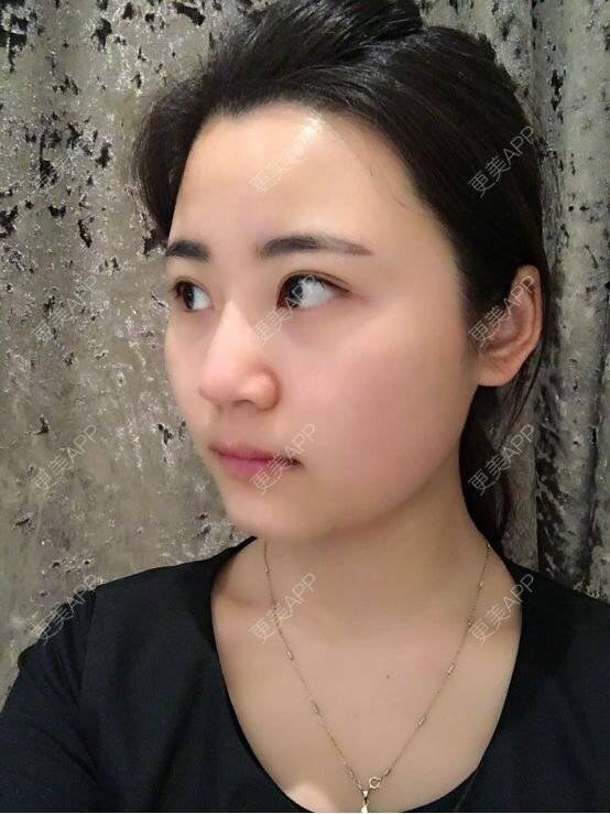 更美 - 上海芙艾门诊部的玻尿酸经验 | 注射美容 | 鼻部整形 | 玻尿酸 | 上海