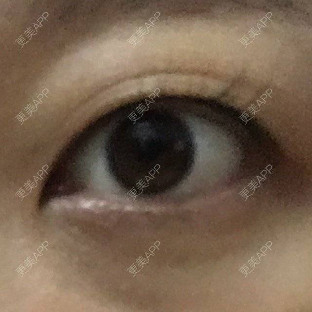 更美 - 转战新_氧，这太垃圾的准分子激光原位角膜磨镶术经验 | 准分子激光原位角膜磨镶术 | 美购日记 | 北京