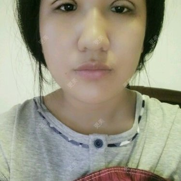 今天刚做的埋线的双眼皮总感觉一个宽一个窄是没消肿的原因吗