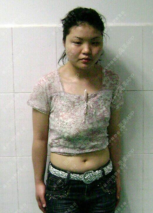 更美 - 宜昌前卫整形美容的假体隆胸经验 | 内窥镜丰胸 | 假体隆胸
