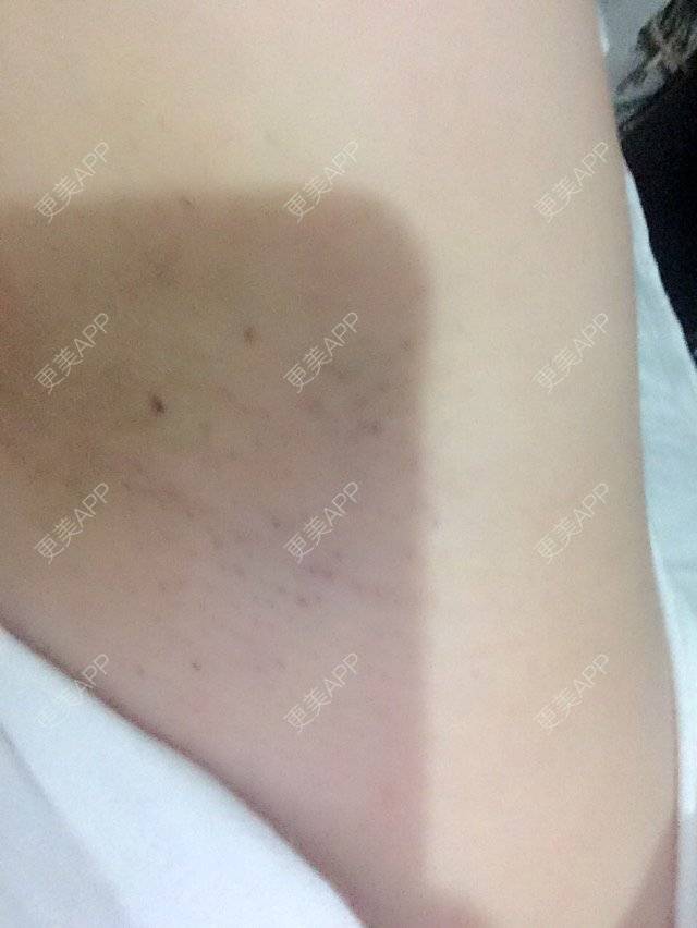 更美 - 洪荒之力要爆发啦的面部脱毛经验 | 杭州 | 面部脱毛 | 杭州瑞丽医疗美容医院 | 超冰脱毛