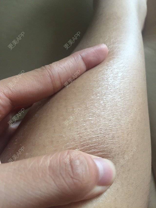 更美 - 15*******09的经验 | 皮肤检测 | 广州