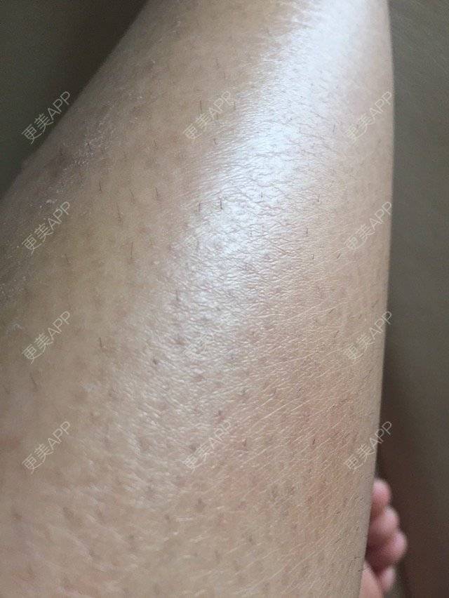 更美 - 15*******09的经验 | 皮肤检测 | 广州