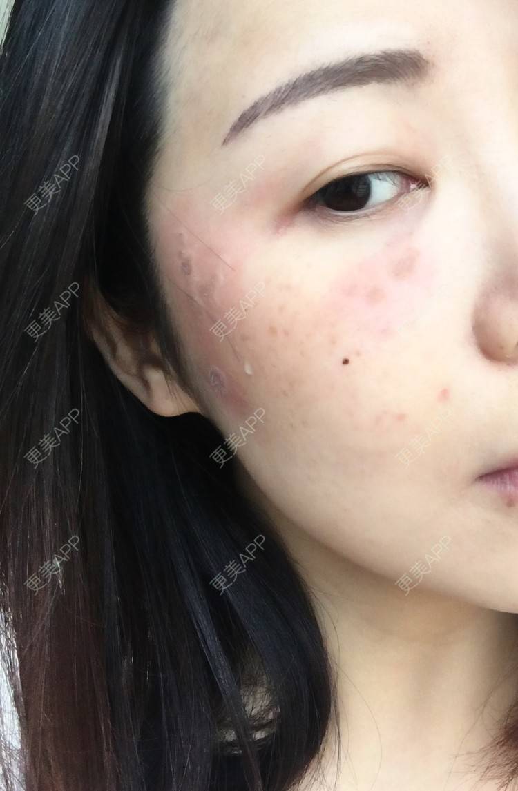 更美 - 丽贝卡卡的激光淡斑经验 | 激光淡斑 | 脂溢性角化 | 老年斑