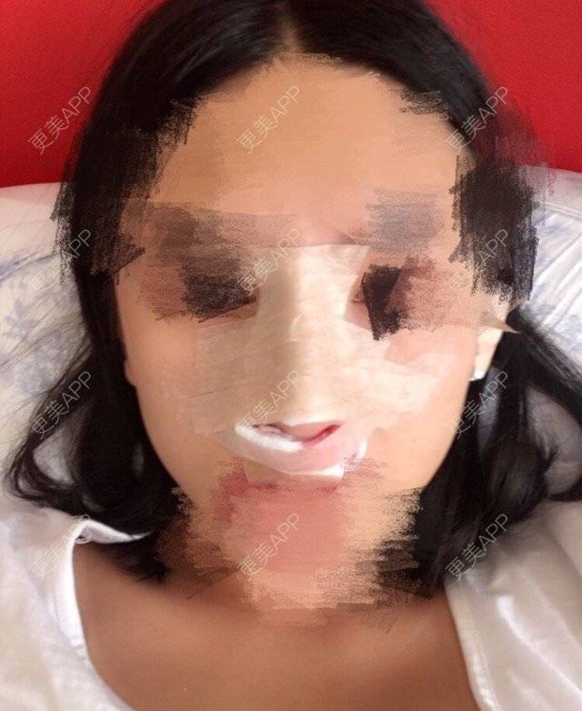 更美 - 如海洋共火焰的鼻部多项经验 | 美购日记 | 鼻头缩小 | 自体软骨垫鼻尖 | 隆鼻 | 上海