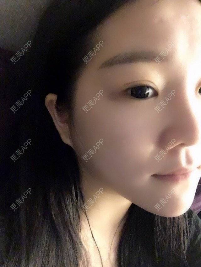 更美 - Mao2小姐的吸脂瘦脸经验 | 美购日记 | 脸部吸脂 | 北京