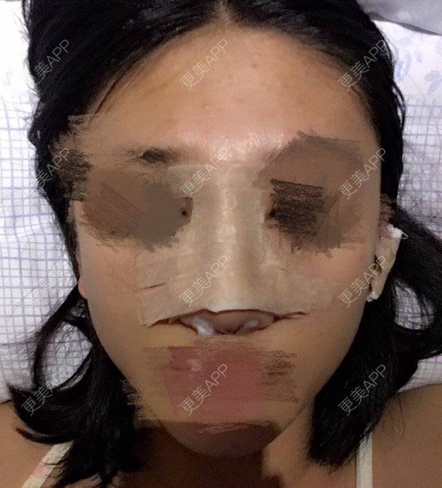 更美 - 如海洋共火焰的鼻部多项经验 | 美购日记 | 鼻头缩小 | 隆鼻手术 | 自体软骨垫鼻尖 | 上海