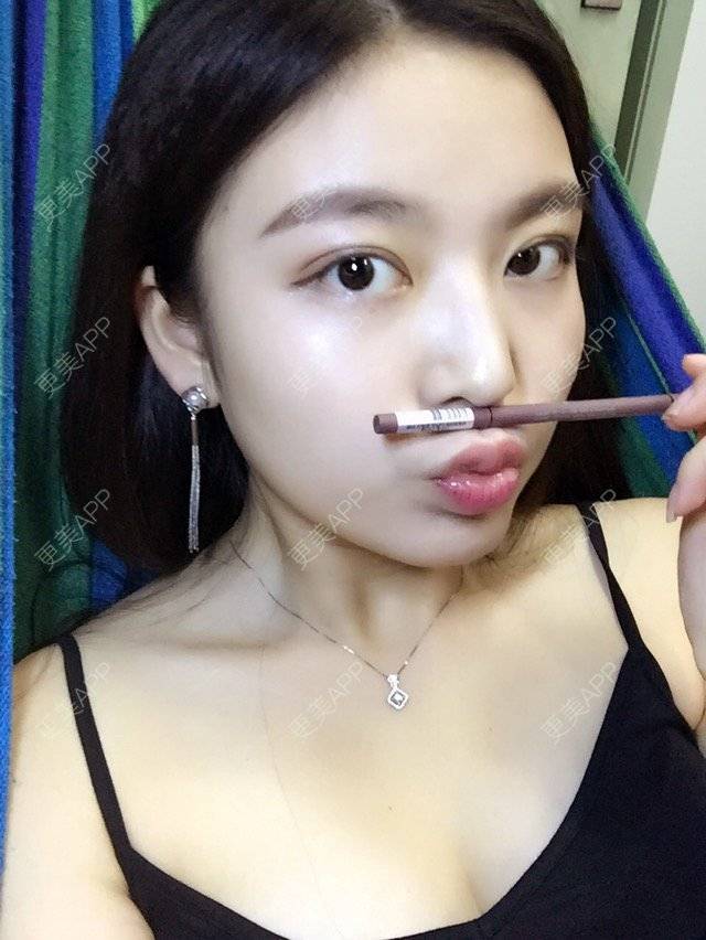 更美 - 彼岸花娇儿的眼皮下垂矫正经验 | 眼皮下垂矫正 | 全切开双眼皮 | 上眼睑下垂矫正术 | 成都