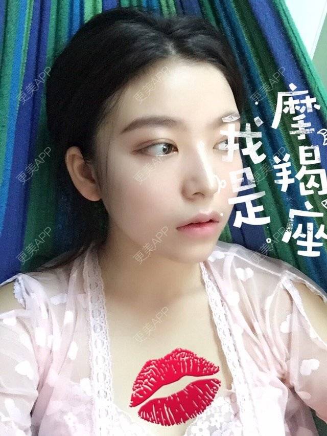 更美 - 彼岸花娇儿的眼皮下垂矫正经验 | 眼皮下垂矫正 | 全切开双眼皮 | 上眼睑下垂矫正术 | 成都