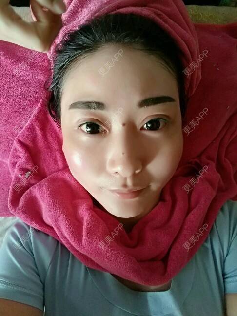 更美 - 天使伊婷的激光淡化红血丝经验 | 美购日记 | 面部红血丝 | 激光淡化红血丝 | 西安