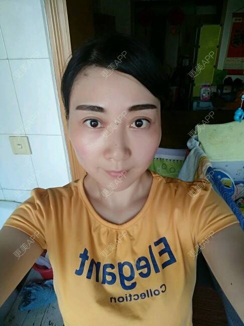 更美 - 天使伊婷的激光淡化红血丝经验 | 美购日记 | 面部红血丝 | 激光淡化红血丝 | 西安