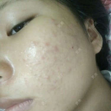 祛疤痕痘印