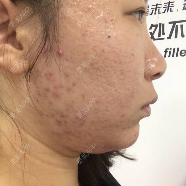 更美 - 18*******60的经验 | 双下巴溶脂
