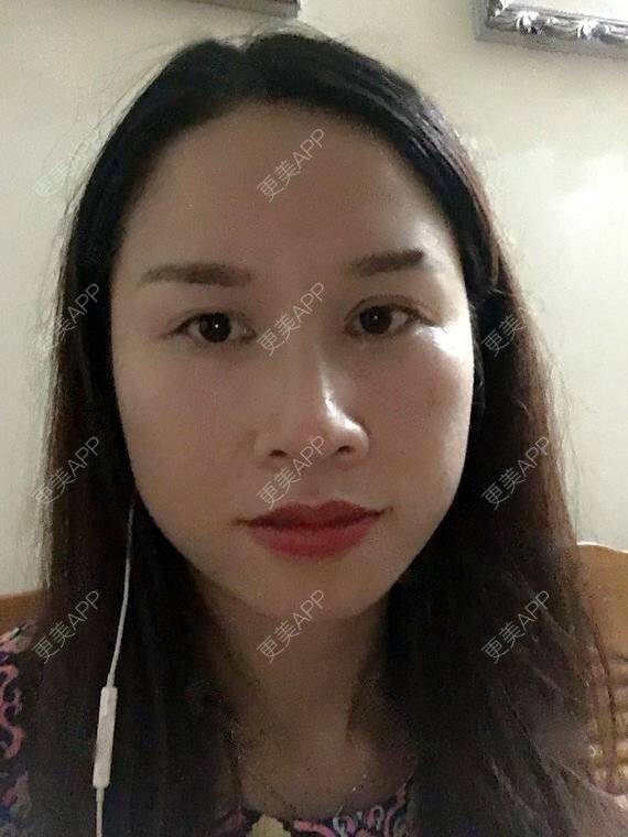 更美 - 玲妹妹的蜕变的自体脂肪隆鼻经验 | 全自体耳软骨隆鼻 | 鼻部整形 | 自体脂肪隆鼻 | 重庆