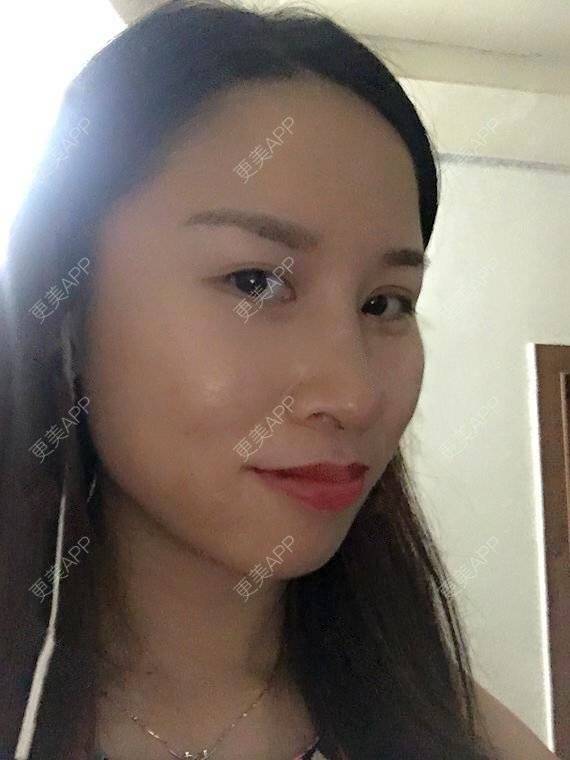 更美 - 玲妹妹的蜕变的自体脂肪隆鼻经验 | 全自体耳软骨隆鼻 | 鼻部整形 | 自体脂肪隆鼻 | 重庆