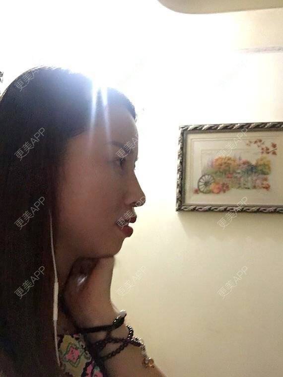 更美 - 玲妹妹的蜕变的自体脂肪隆鼻经验 | 全自体耳软骨隆鼻 | 鼻部整形 | 自体脂肪隆鼻 | 重庆